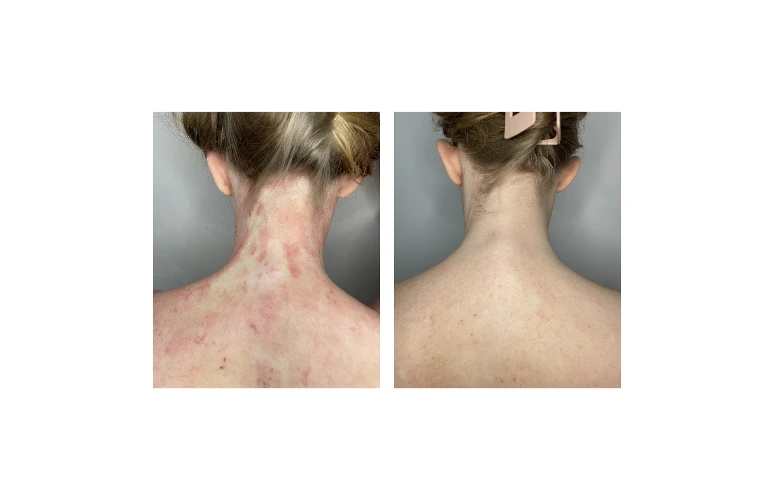 Before after results TSW Clinic