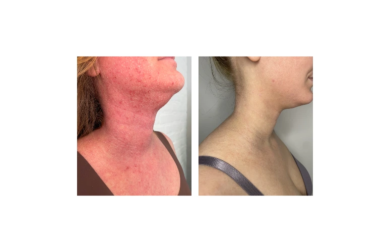 Before after results TSW Clinic