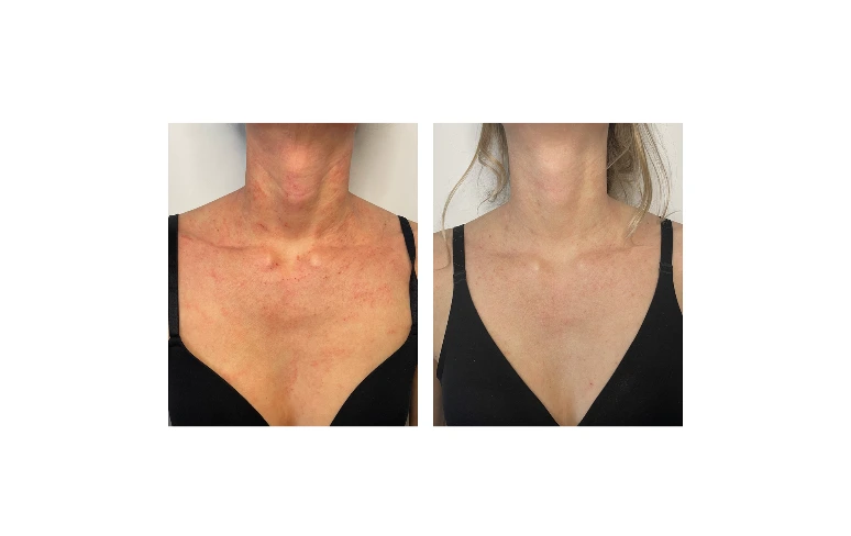 Before - after TSW Clinic